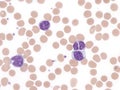 B-cell prolymphocytic leukemia with binucleated lymphocytes. Peripheral blood. Royalty Free Stock Photo