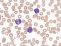 B-cell prolymphocytic leukemia with binucleated lymphocytes. Peripheral blood. Royalty Free Stock Photo