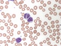 B-cell prolymphocytic leukemia with binucleated lymphocytes. Peripheral blood. Royalty Free Stock Photo
