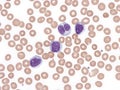 B-cell prolymphocytic leukemia with binucleated lymphocytes. Peripheral blood. Royalty Free Stock Photo