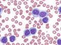 B-cell prolymphocytic leukemia. Royalty Free Stock Photo