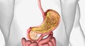 B12 and intrinsic factor in the stomach
