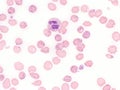 Babesiosis in peripheral blood.