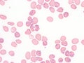 Babesiosis in peripheral blood. Royalty Free Stock Photo