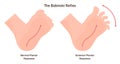 Babinski reflex. Stimulation of the lateral plantar aspect of the foot leads