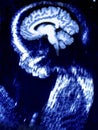 Baby Brain Ultrasound CT Scan
