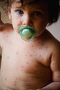 Chicken pox pustule