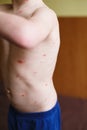 Baby with chicken pox rash. Varicella virus or Chickenpox bubble rash on child. Dermatology concept