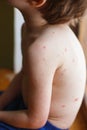 Baby with chicken pox rash. Varicella virus or Chickenpox bubble rash on child. Dermatology concept