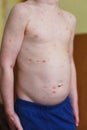 Baby with chicken pox rash. Varicella virus or Chickenpox bubble rash on child. Dermatology concept