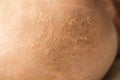 Baby crust on the head. Seborrheic crust on baby head, close-up, Seborrheic dermatitis, inflammatory.