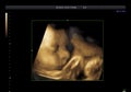 Baby 3d ultrasound