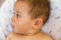 Baby with dermatitis problem of rash. Allergy suffering from food allergies. Close-up atopic symptom on skin cheeks. concept