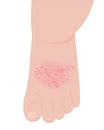 A baby foot affected with eczema