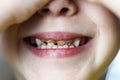 . baby girl is in the chair at the dentist. hands closes his eyes. front teeth in caries. shallow depth of cut. there is toning