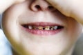 . baby girl is in the chair at the dentist. hands closes his eyes. front teeth in caries. shallow depth of cut. there is toning