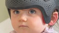 Baby girl wearing a cranial remoulding helmet flat head