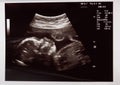 Baby head on ultrasound scan