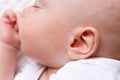 baby infant dermatitis allergic skin Royalty Free Stock Photo