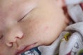 Baby rash close up Royalty Free Stock Photo