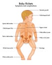 Baby rickets symptoms