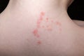 baby skin rash and allergy with red spot cause Royalty Free Stock Photo