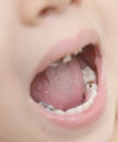 Baby teeth with caries Royalty Free Stock Photo