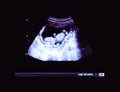 Baby ultrasound, 2D echo