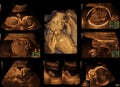 Baby on the ultrasound image