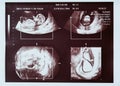 Baby on ultrasound. 20 weeks gestation. Collage, different angles.