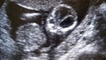 Baby in uterus 19 weeks ultrasound image Royalty Free Stock Photo