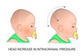 The babys head during intracranial pressure