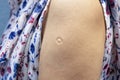 Bacillus Calmette-Guern Vaccine,  BCG or TB vaccine scar mark at the arm of Asian women. Royalty Free Stock Photo