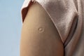 Bacillus Calmette-Guern Vaccine,  BCG or TB vaccine scar mark at the arm of Asian women. Royalty Free Stock Photo