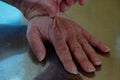 The back of the hand is being used for the turgor test for dehydration