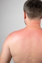 Back of a man with a sunburn, close-up. Royalty Free Stock Photo