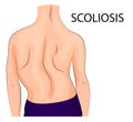 Back, a scoliosis of the fourth degree Royalty Free Stock Photo