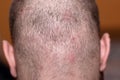 Back side of a man`s head suffering from scalp acne