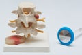 Herniated lumbar disc model and a reflex hammer on white background