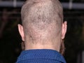 Back view of a bald man suffering from scalp acne