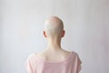 Back view of bald woman with medical condition causing hair loss like Alopecia Areata or chemotherapy