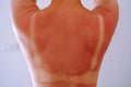 Back view of young woman with light traces of swimsuit on sunburnt naked back raise hands on blue background. UV rays.