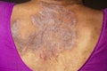 Back of woman with psoriasis close up stock photo