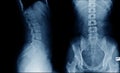 back x-ray image AP and lateral view in blue tone Royalty Free Stock Photo