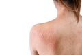 Back of young asian woman have itchy with allergy rash on white background, Selective focus, Health allergy skin care problem Royalty Free Stock Photo