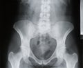 Backbone, pelvis, socket of hip joint, thigh bone x-ray, osteoporosis