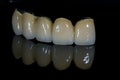 Metal ceramic bridge tooth unit