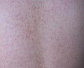 Background of human skin with allergic red spots on back body Royalty Free Stock Photo