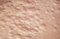 background of the texture human skin is covered with fine wrinkles ,cracked and blistered from the burn and allergies