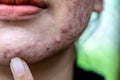 Backgrounds of lesions skin caused by acne on the face.